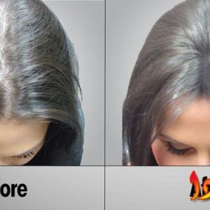 علاج تساقط الشعر روشته ب 50 جنيه